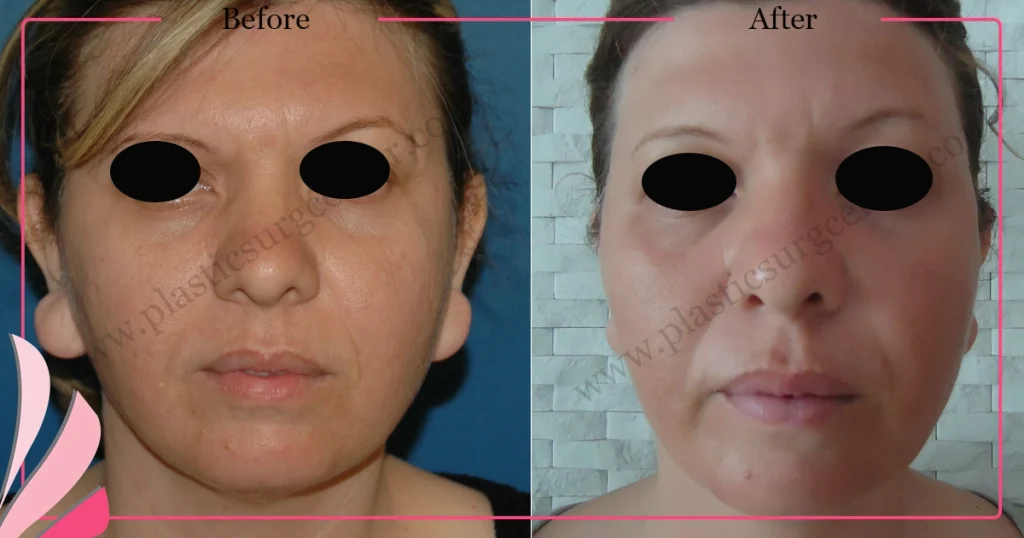 Otoplasty, Prominent ear surgery - Case 9 - Front View