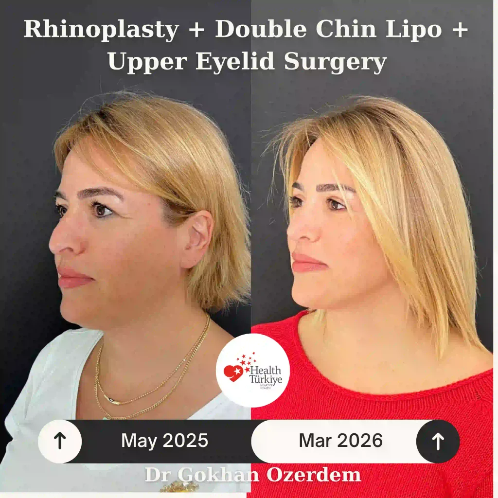Rhinoplasty in Turkey - Case 10 - Female - Left Oblique