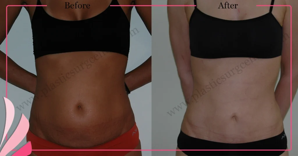 Abdominal liposuction in turkey - Case 5 - Front View
