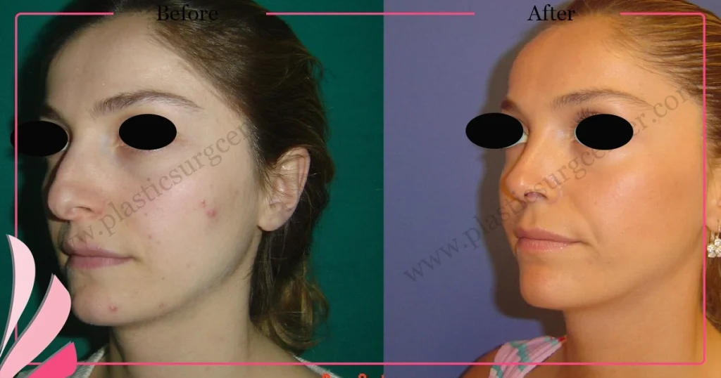 Rhinoplasty in Turkey - Case 25 - Female - Oblique View