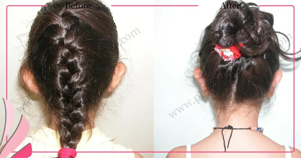 Otoplasty, Prominent ear surgery - Case 12 - Back View
