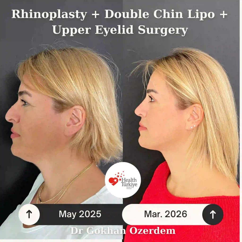 Rhinoplasty in Turkey - Case 10 - Female - Left Profile