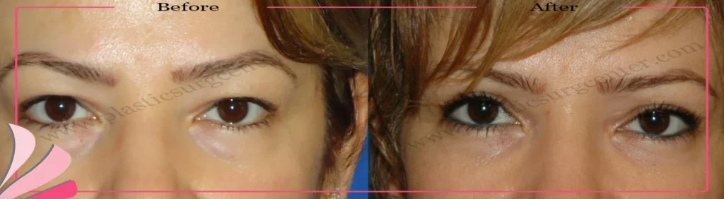 Upper eyelid surgery - case 29 - Front view
