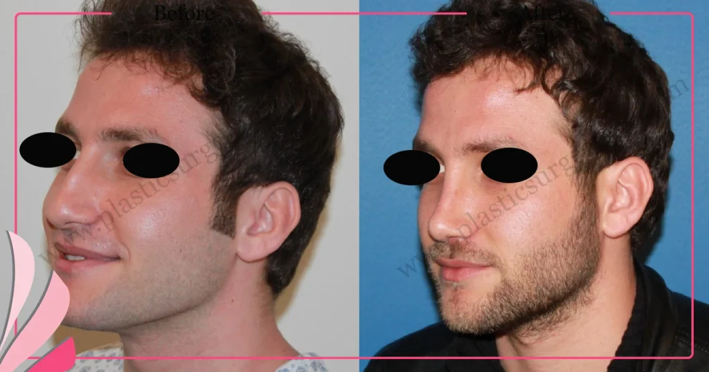 Rhinoplasty in Turkey - Case 30 - Male - Oblique View