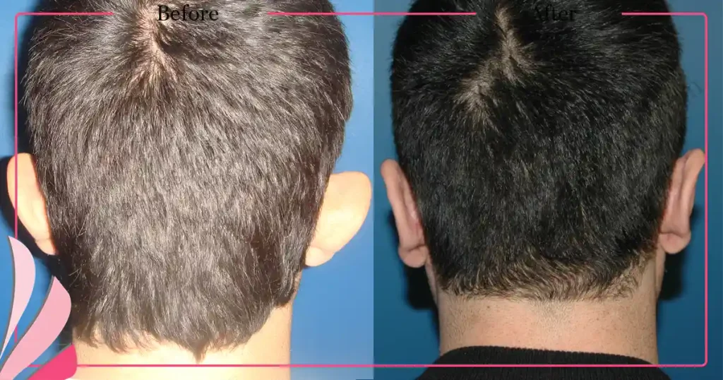 Otoplasty, Prominent ear surgery - Case 5 - Back View