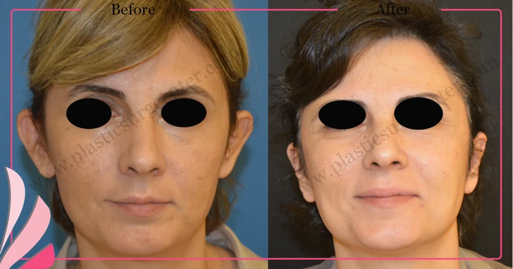 Otoplasty, Prominent ear surgery - Case 11 - Front View