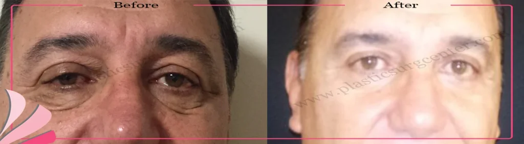 Upper and lower eyelid surgery - case 21 - Front view