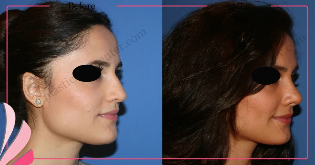 Rhinoplasty in Turkey - Case 28 - Female - Oblique View