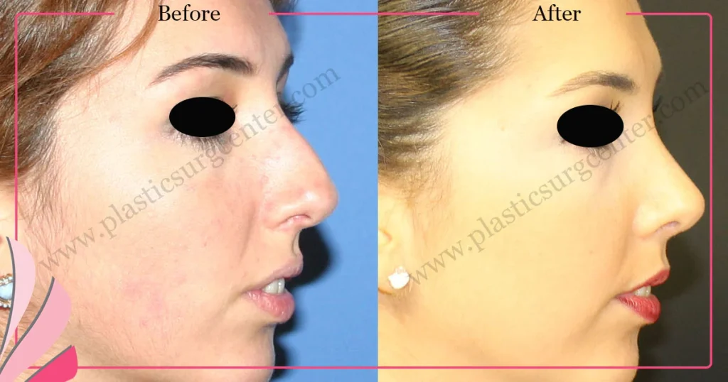 Rhinoplasty in Turkey - Case 29 - Female - Right Profile