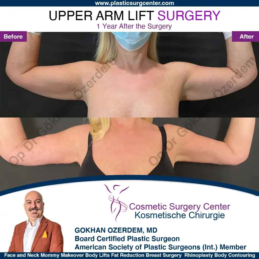 Arm Lift in Turkey, Case 1 - Front View