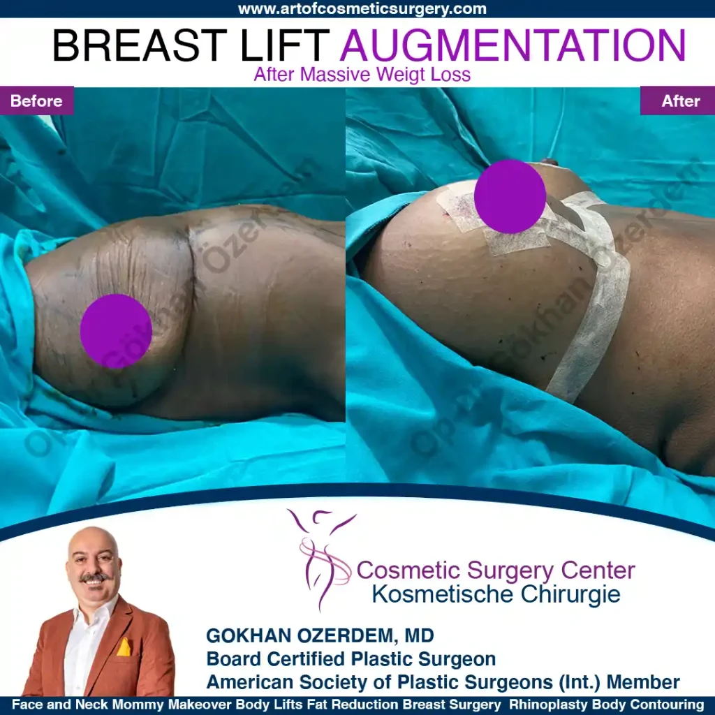 Breast Lift in Turkey, Case 16- Right Side - In the operation room