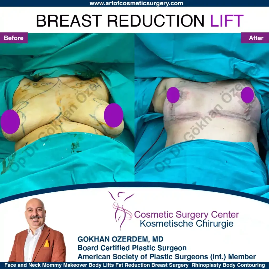 Breast Lift in Turkey, Case 11- Front Side - In the operation room
