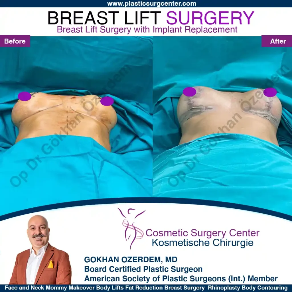 Breast Lift in Turkey, Case 14- Front Side - In the operation room