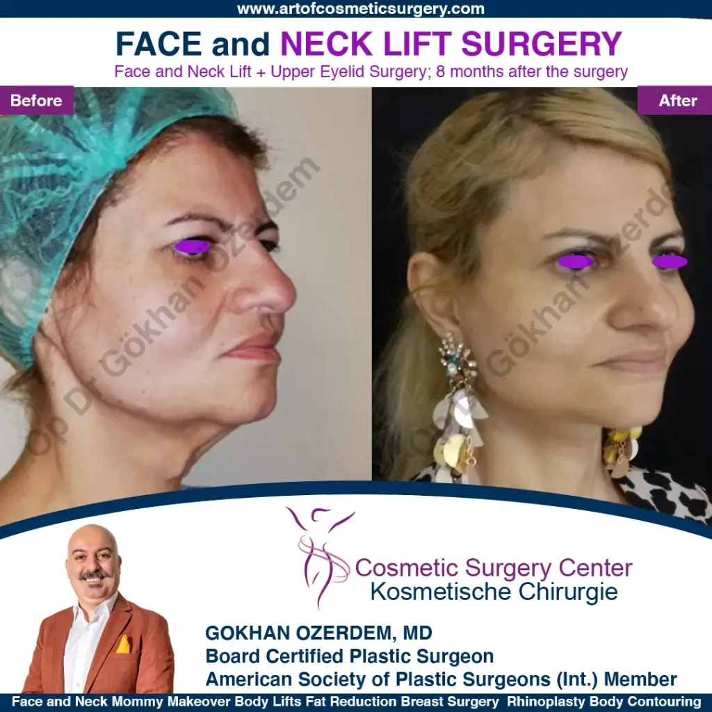 Facelift before and after - Case 2, Oblique view