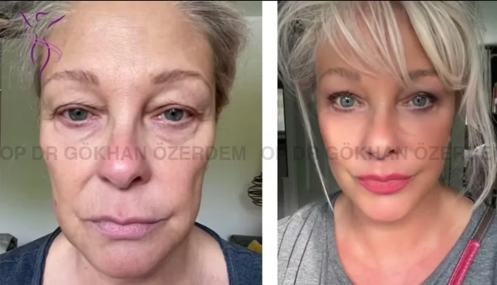 Facelift before and after - Case 6, Front View