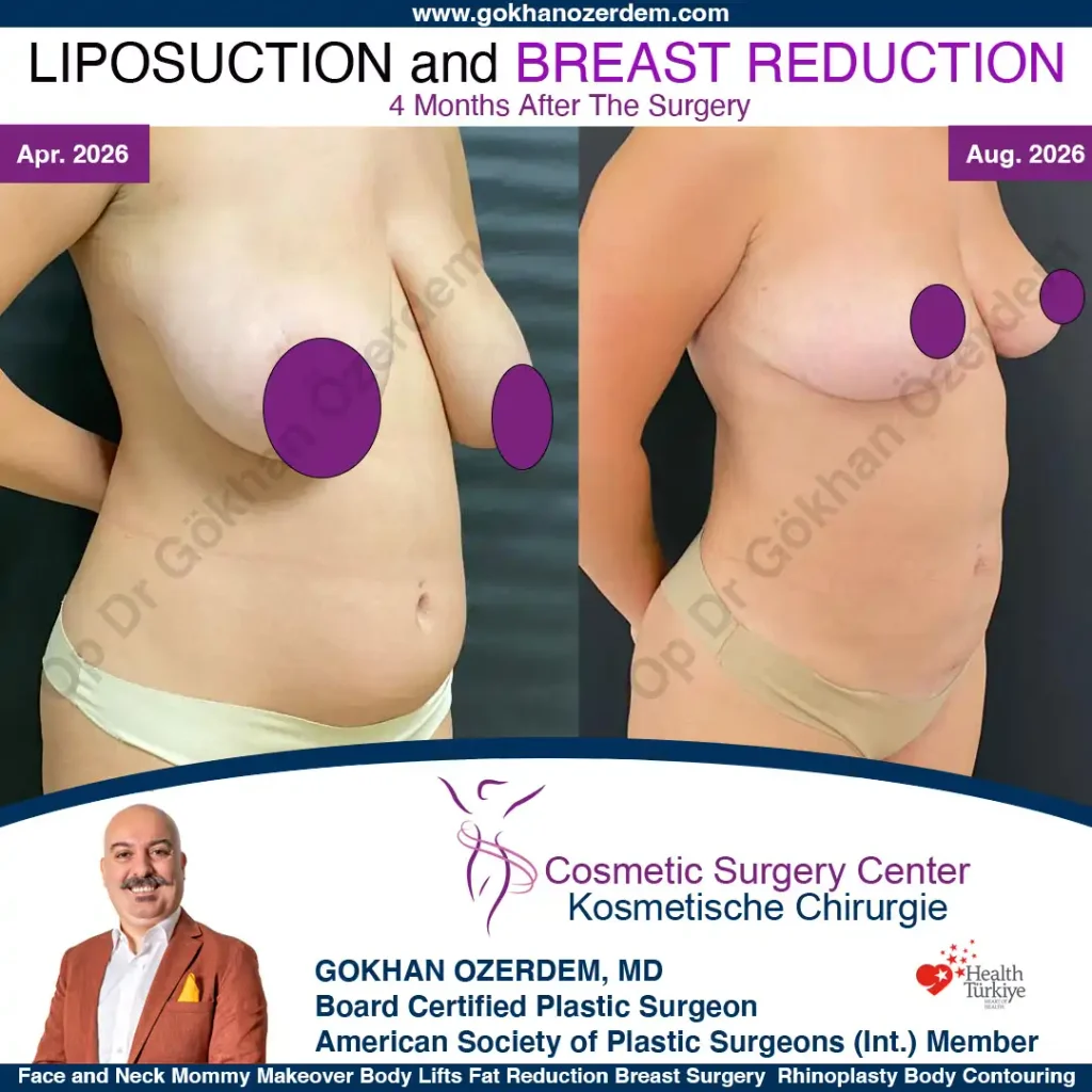 Liposuction in Turkey - Case 1 - Oblique View