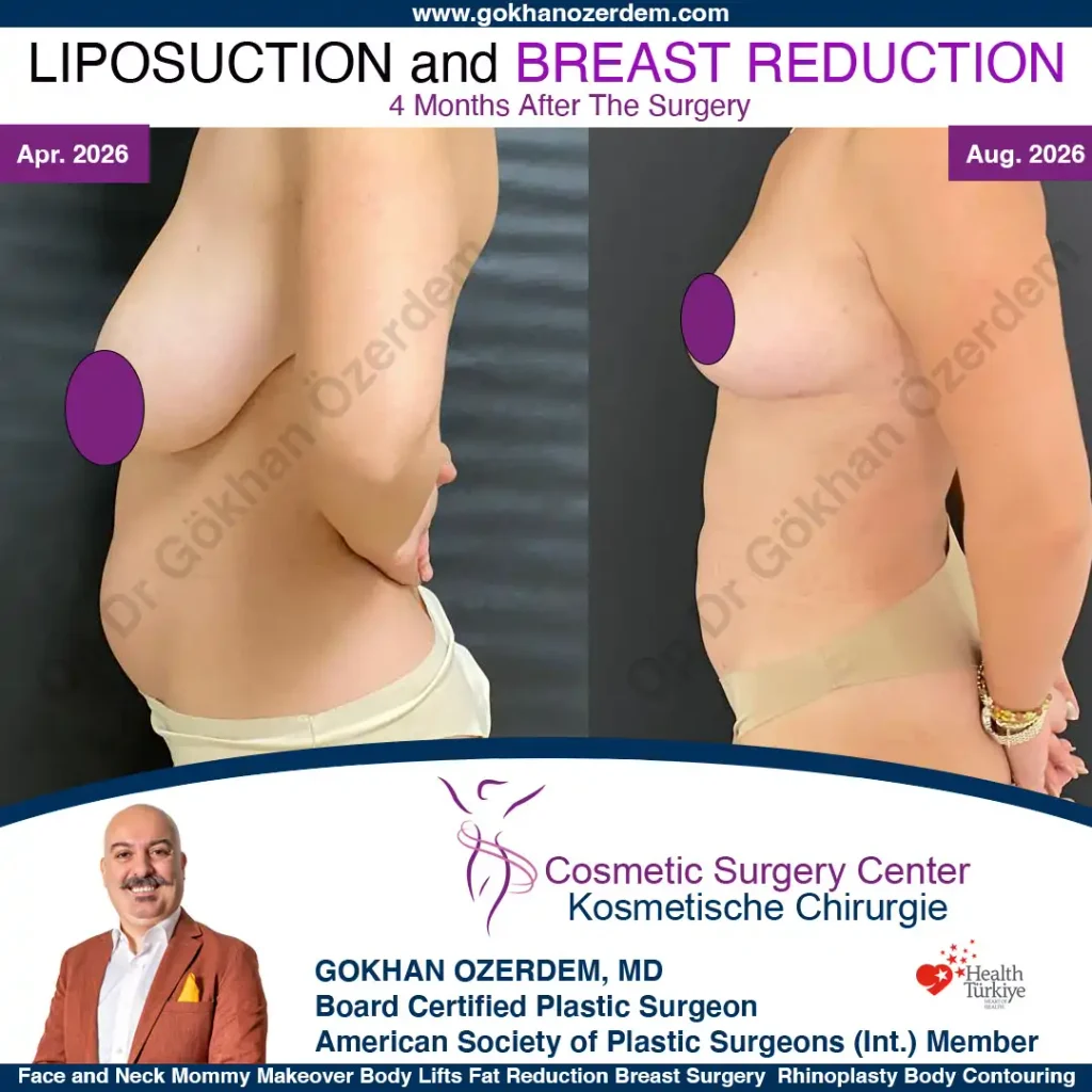 Liposuction in Turkey - Case 1 - Front view - Left Side