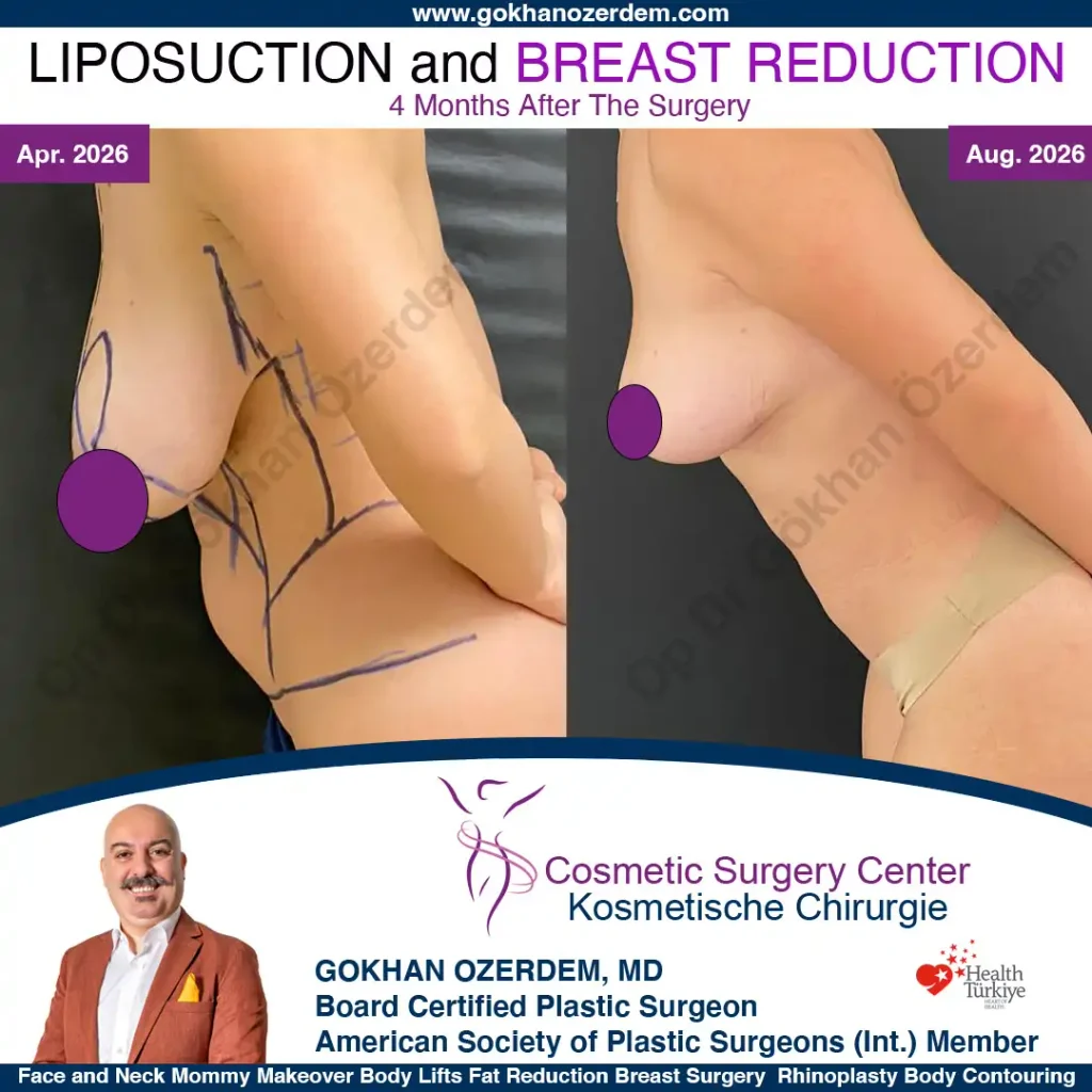 Liposuction in Turkey - Case 1 - Front view - leaning forward