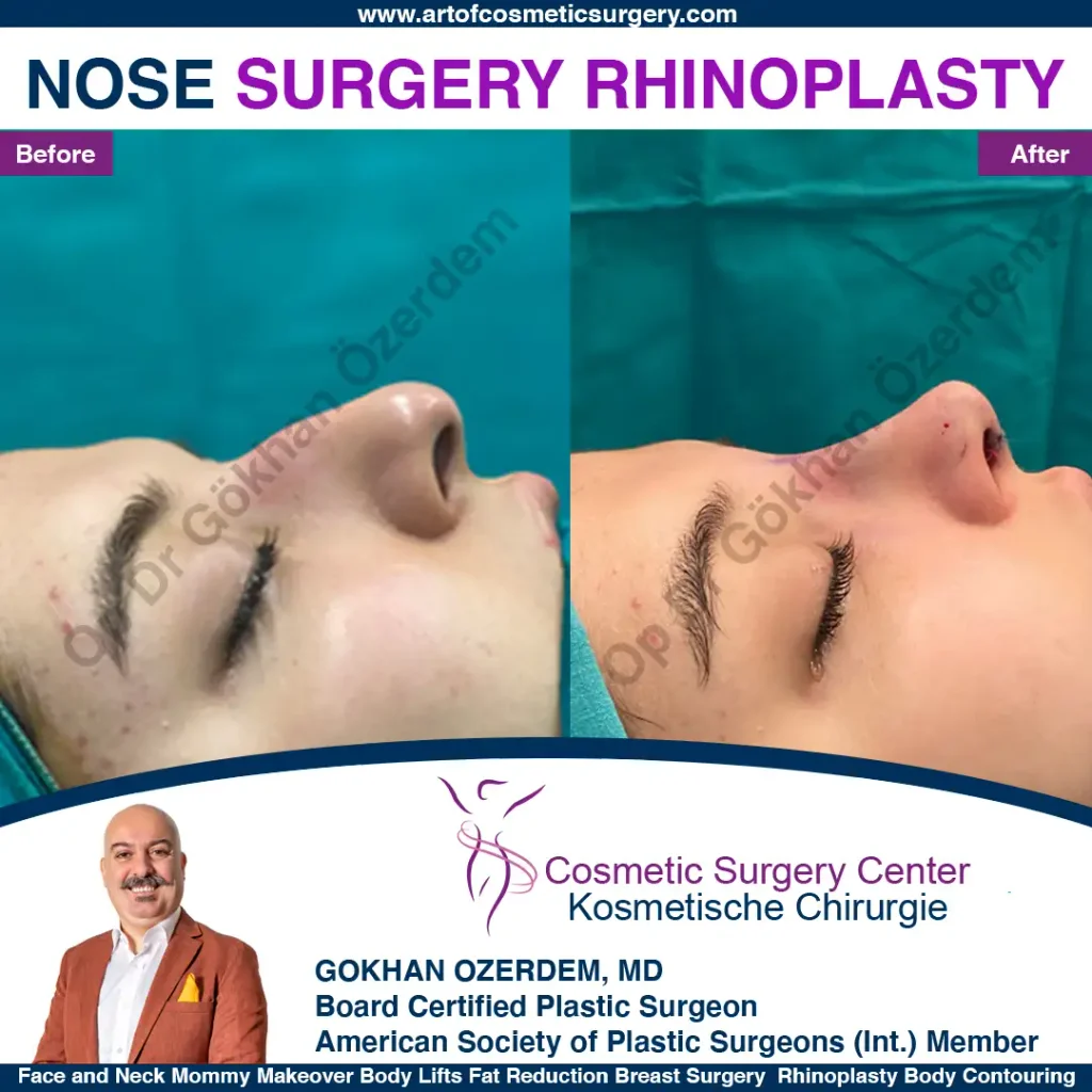 Rhinoplasty in Turkey - Case 16 - Female - Right Profile