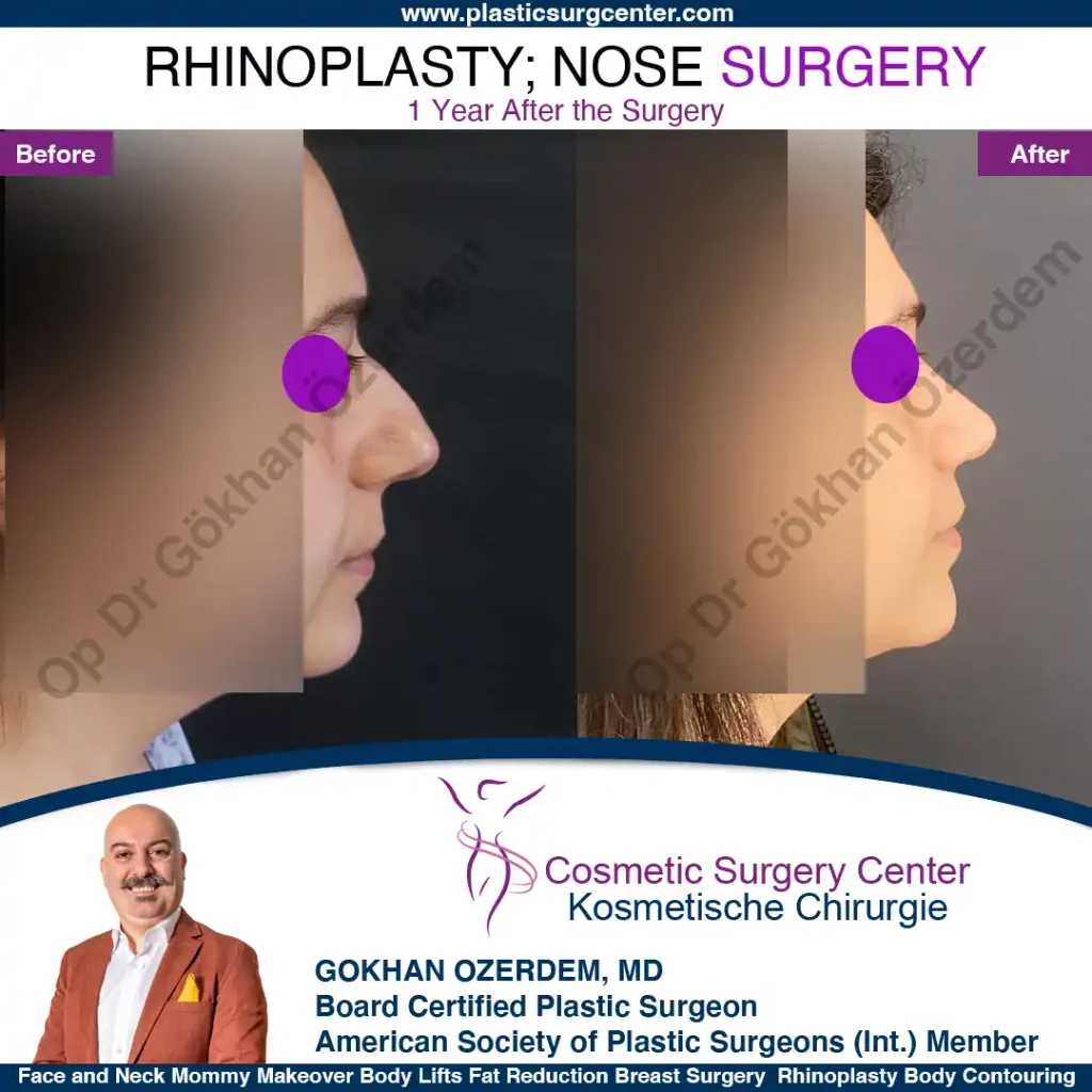 Rhinoplasty in Turkey - Case 9 - Female - Right Profile