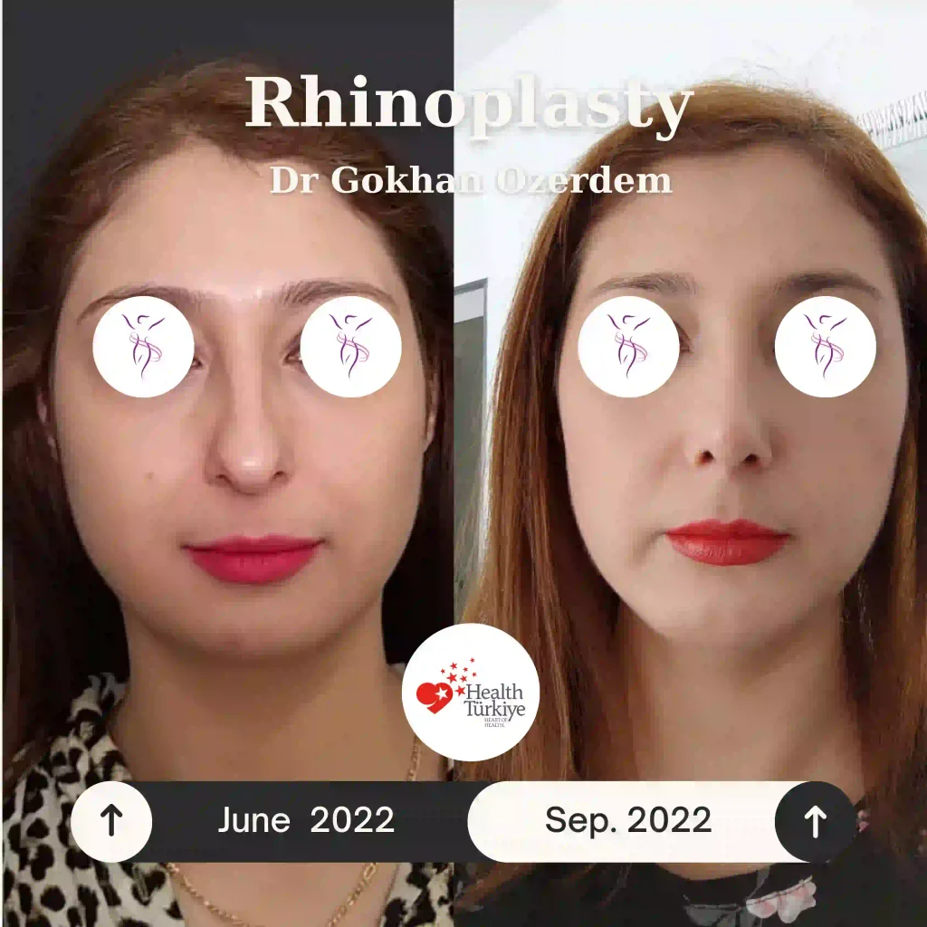 Rhinoplasty in Turkey - Case 8 - Female - Front