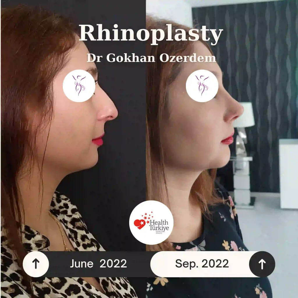 Rhinoplasty in Turkey - Case 8 - Female - Right Profile