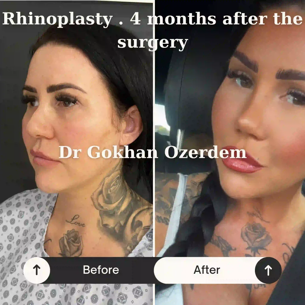 Rhinoplasty in Turkey - Case 12 - Female - Left Oblique