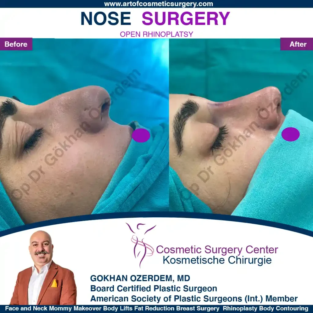 Rhinoplasty in Turkey - Case 14 - Female - Right Profile