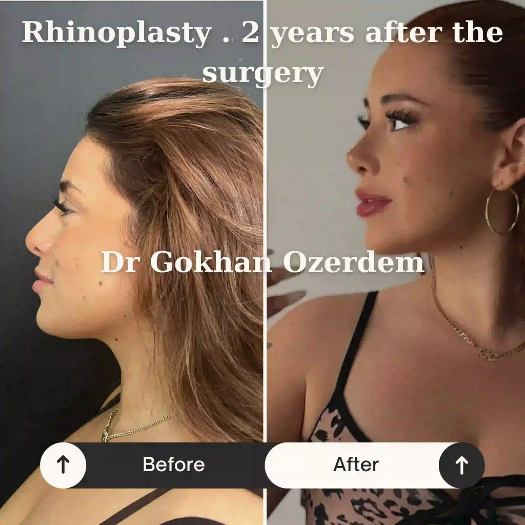 Rhinoplasty in Turkey - Case 13 - Female - Left Profile