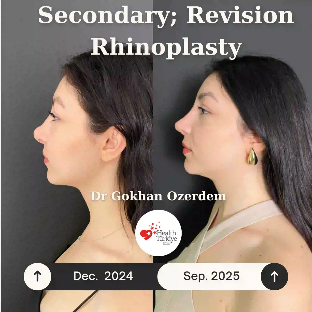 Rhinoplasty in Turkey - Case 11 - Female - Left Profile