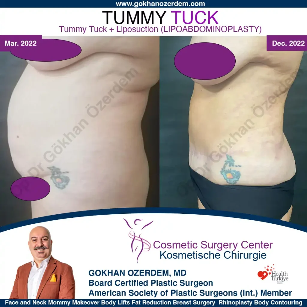 Tummy tuck in Turkey - Case 1 - Left Side