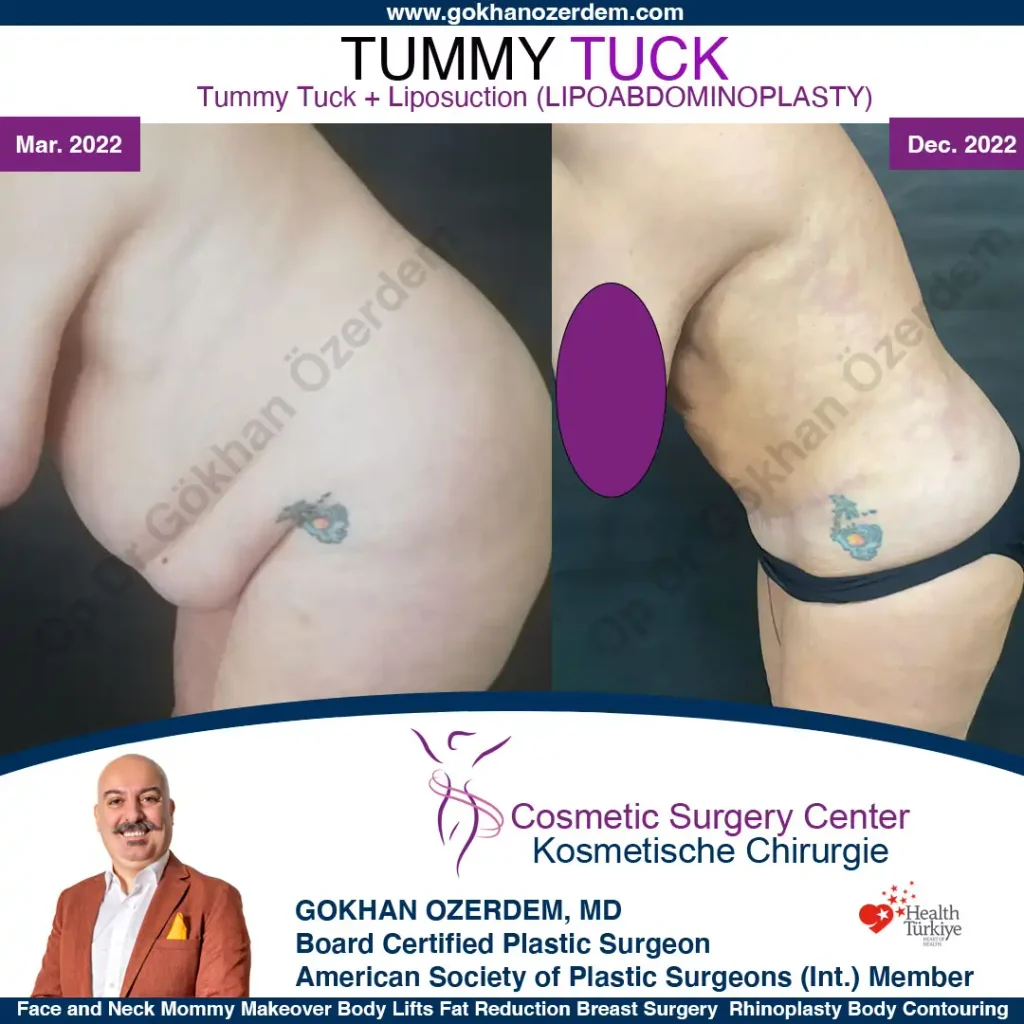 Tummy tuck in Turkey - Case 1 - Leaning Front