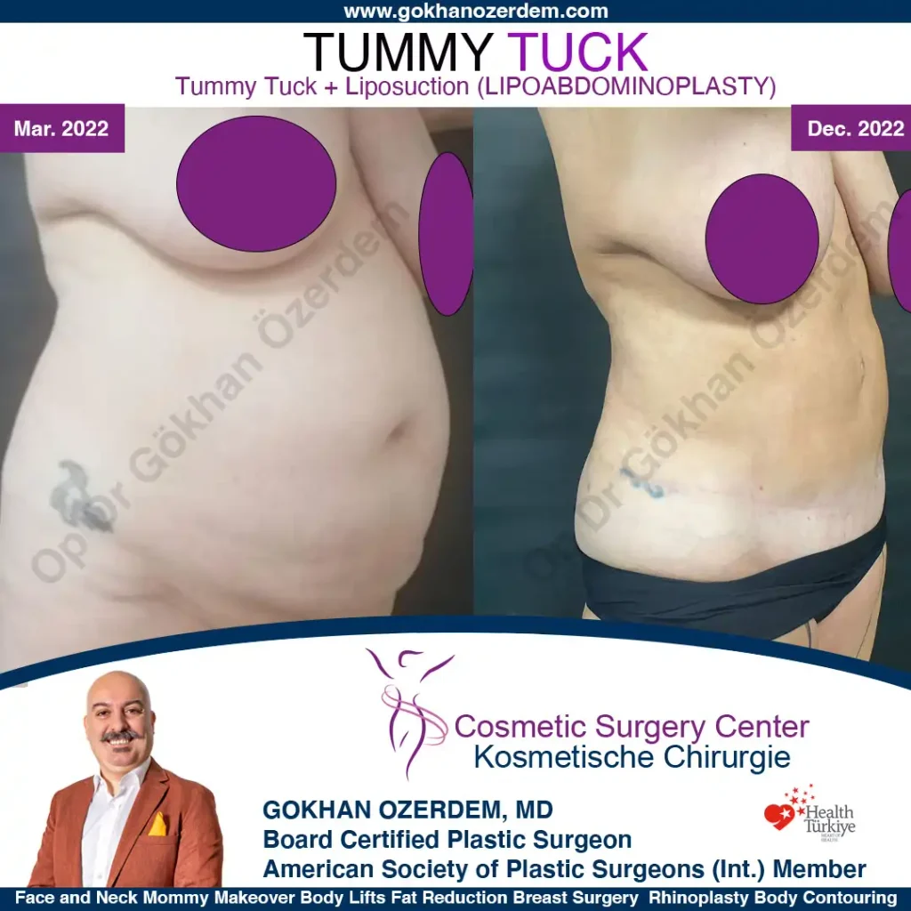 Tummy tuck in Turkey - Case 1 - Oblique View