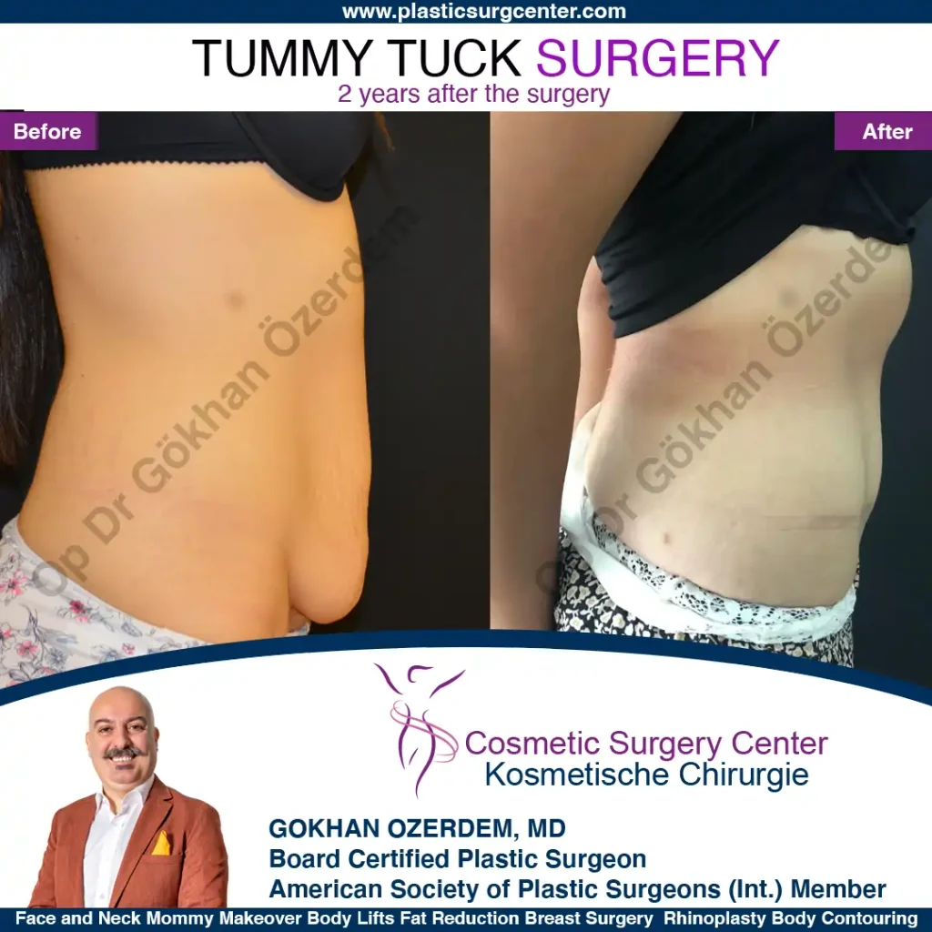 Tummy tuck in Turkey - Case 8 - Right Side