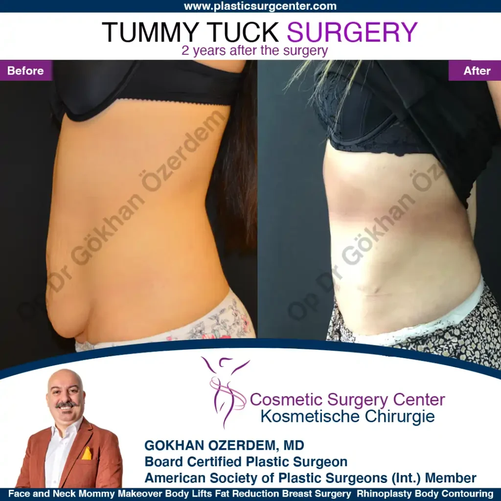 Tummy tuck in Turkey - Case 8 - Left Side