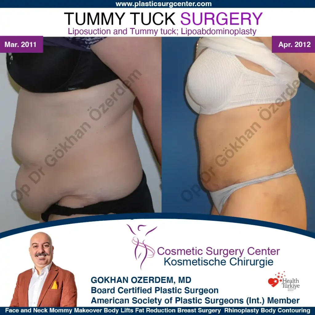 Tummy tuck in Turkey - Case 5 - Left Side