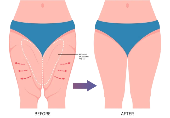 Body Contouring After Weight Loss in Turkey Antalya Dr Gokhan Ozerdem