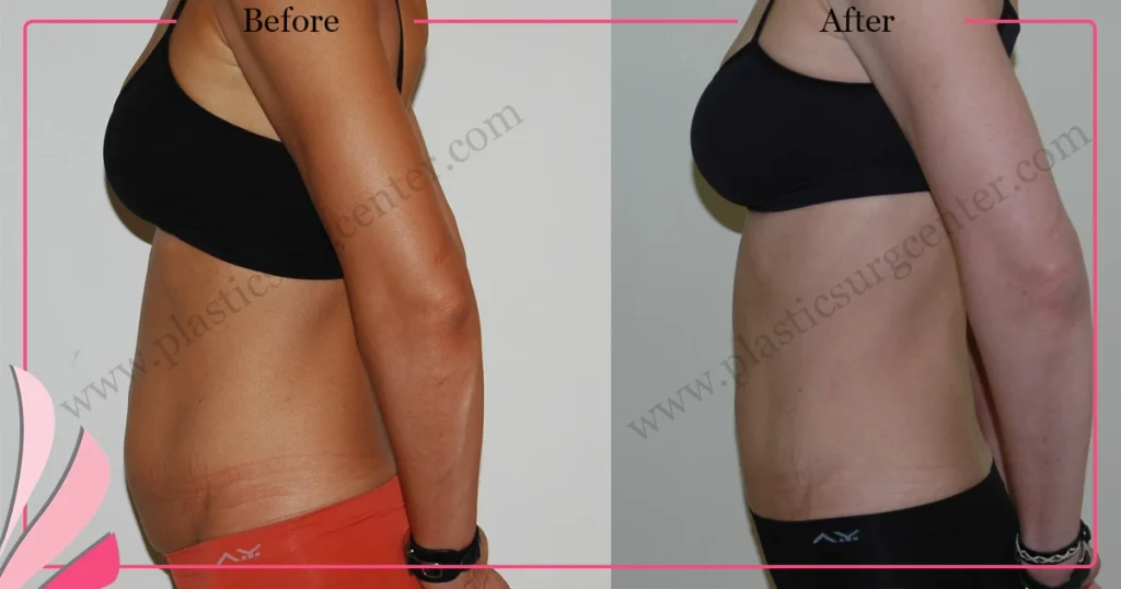Abdominal liposuction in turkey - Case 5 - Left Side