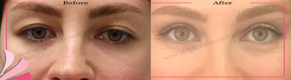 Upper eyelid surgery - case 26 - Front view