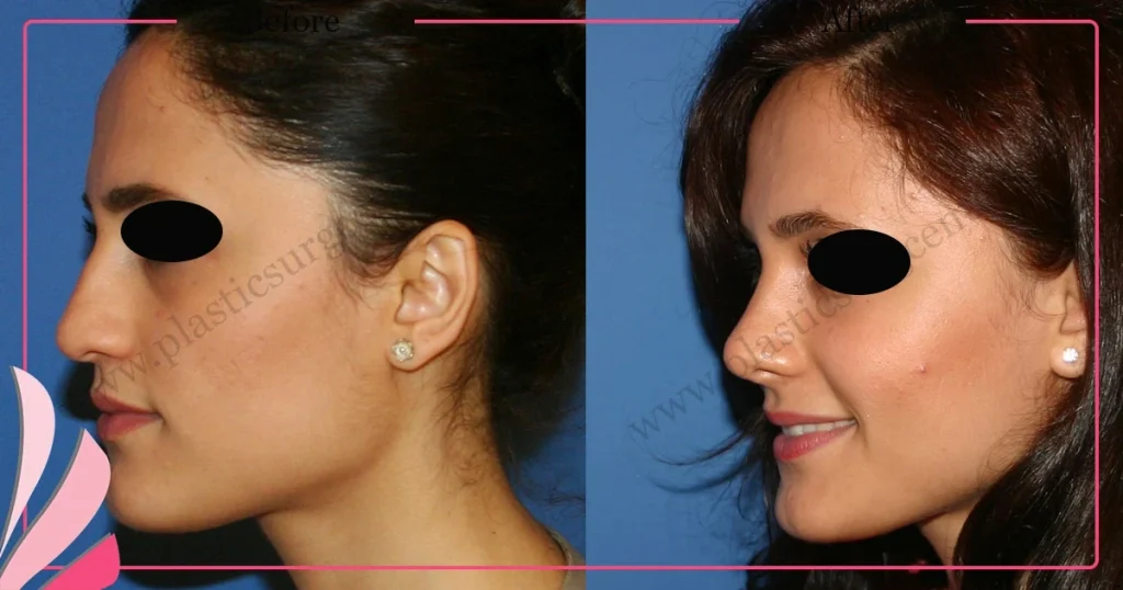 Rhinoplasty in Turkey - Case 28 - Female - Left Profile