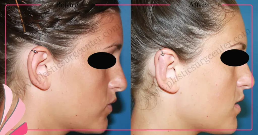 Otoplasty, Prominent ear surgery - Case 8 - Right profile