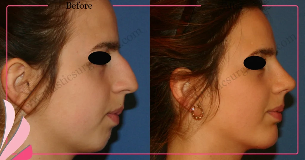 Rhinoplasty in Turkey - Case 27 - Female - Right Profile