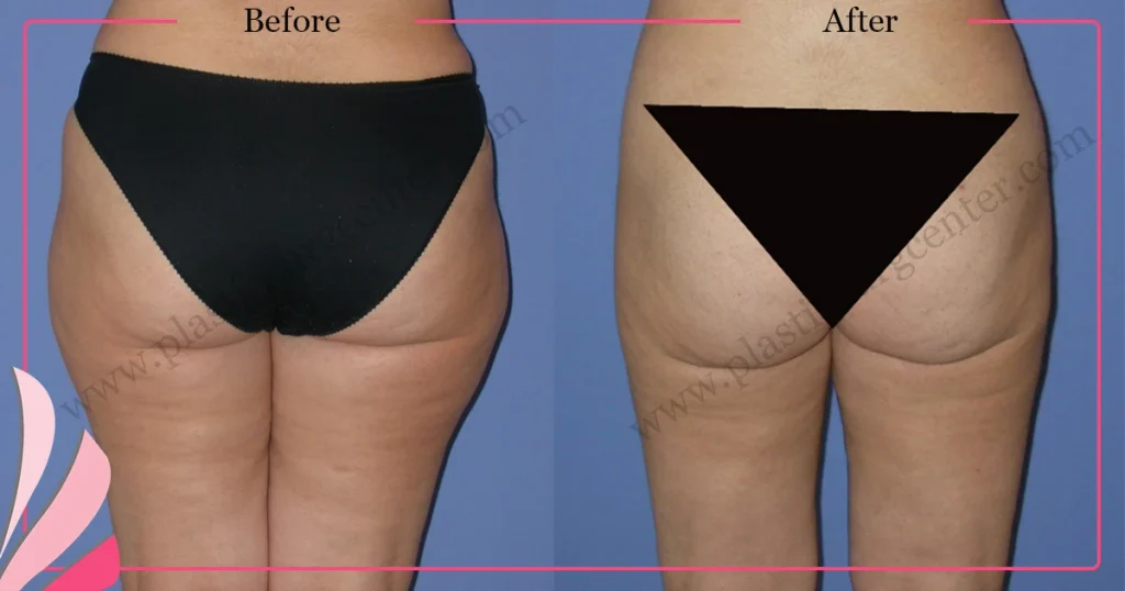 Liposuction in Turkey - Case 4 - Back view