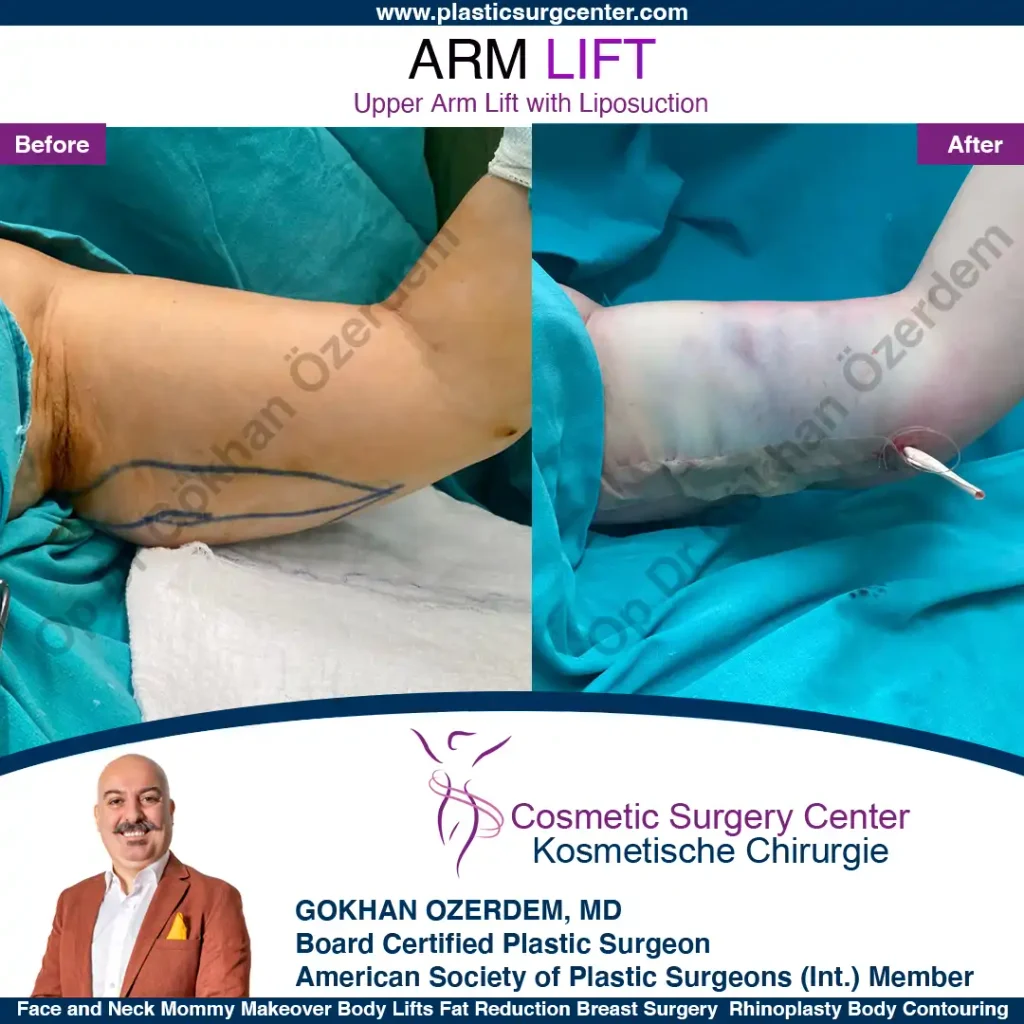 Arm Lift in Turkey, Case 6 - Left Arm