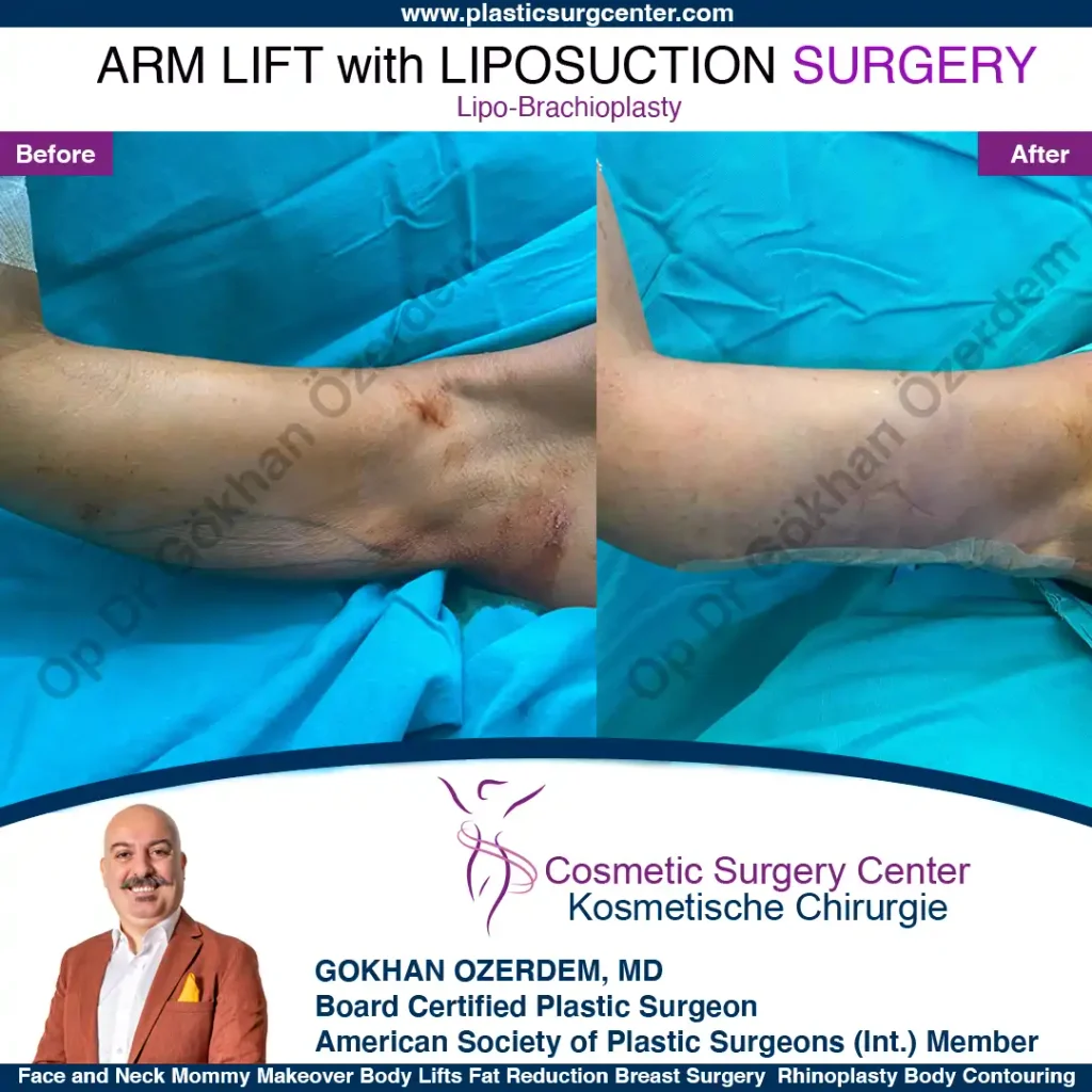 Arm Lift in Turkey, Case 10 - Right Arm