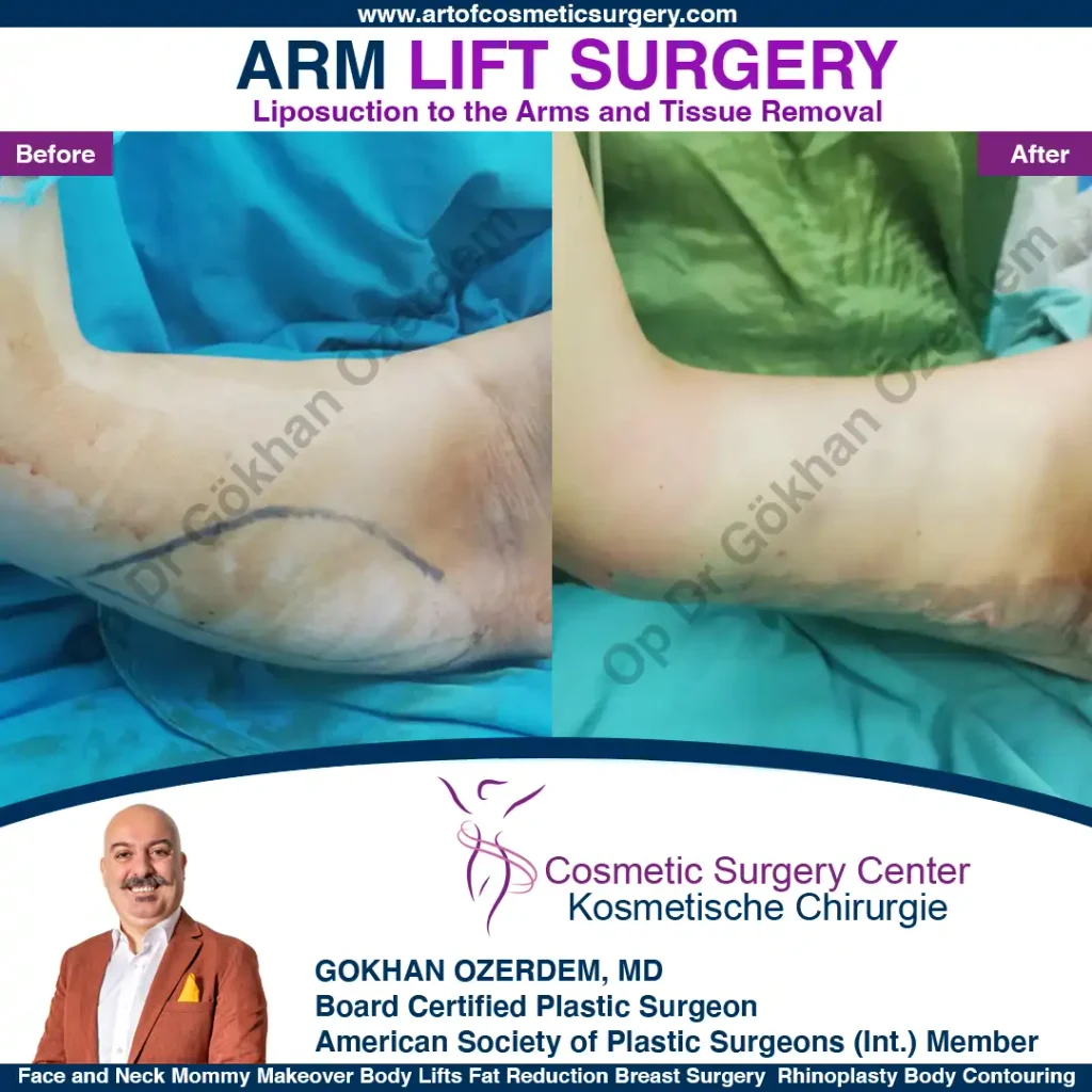 Arm Lift in Turkey, Case 9 - Right Arm