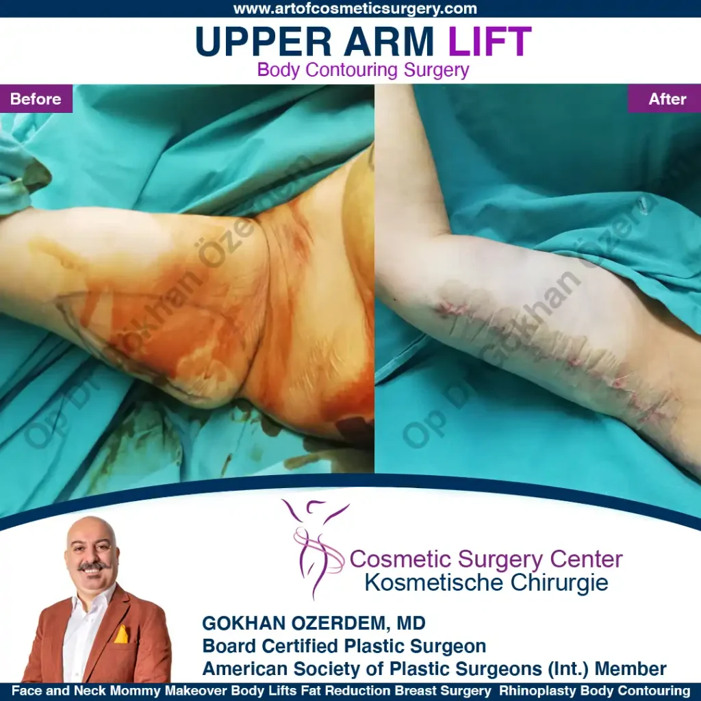 Arm Lift in Turkey, Case 8 - Right Arm