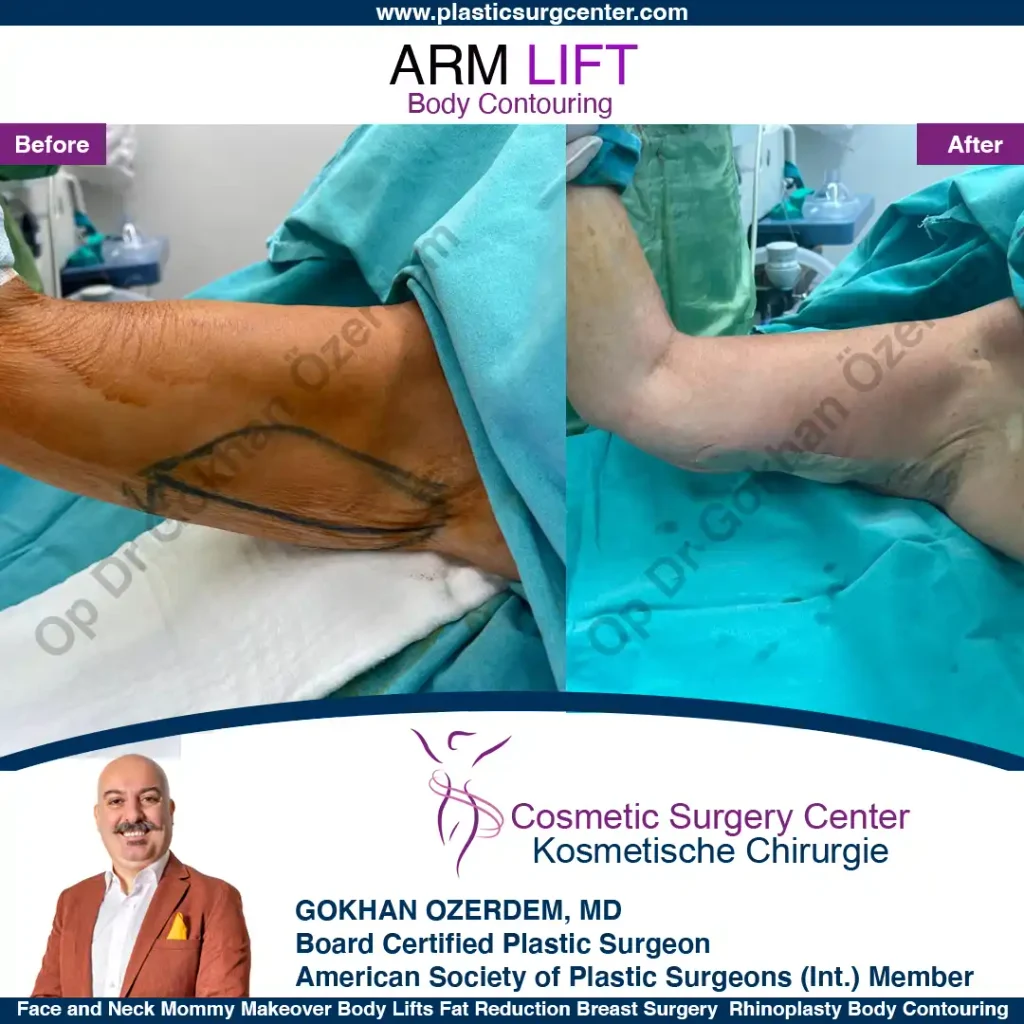 Arm Lift in Turkey, Case 5 - Right Arm