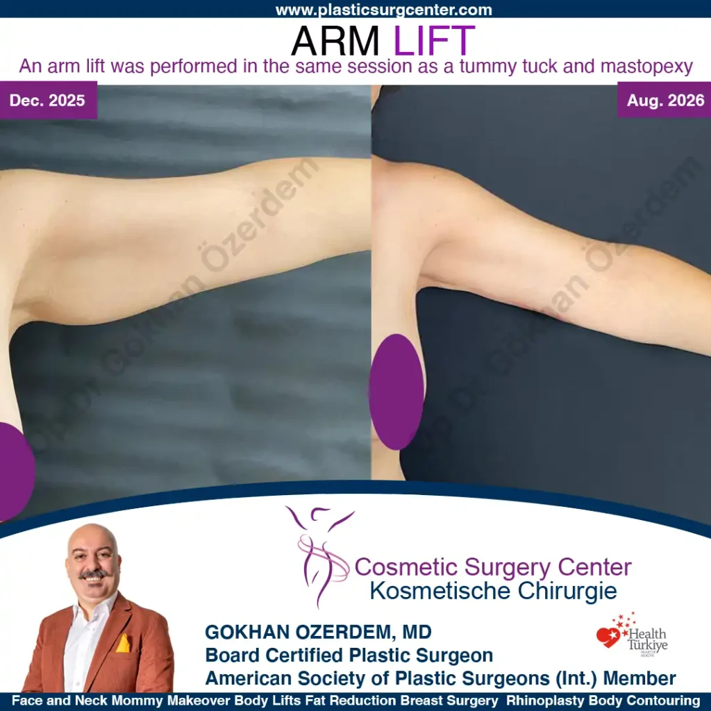 Arm Lift in Turkey, Case 11 - Left Arm