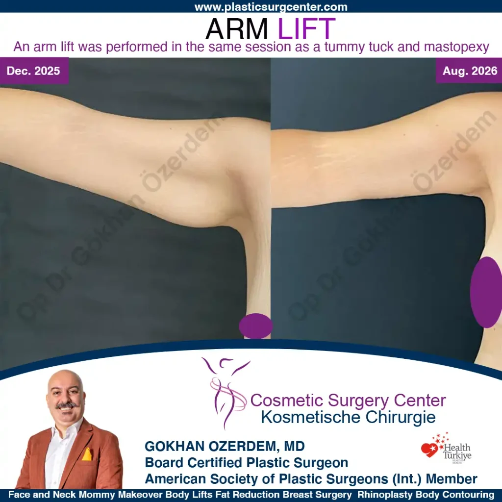 Arm Lift in Turkey, Case 11 - Right Arm